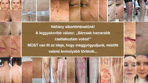 ✅ 𝙎𝙈𝘼𝙎𝙐𝙊® Fekete Rizses Bőrregeneráló Krém 👨‍⚕️ (Szemölcsök, bőrkinövések, foltok és hiperpigmentáció kezelésére)🍀