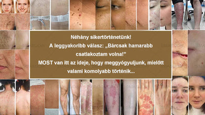 ✅ 𝙎𝙈𝘼𝙎𝙐𝙊® Fekete Rizses Bőrregeneráló Krém 👨‍⚕️ (Szemölcsök, bőrkinövések, foltok és hiperpigmentáció kezelésére)🍀